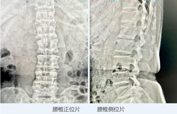手术快讯|首都医科大学附属北京友谊医院祝斌教授开展Mega大通道脊柱内镜下腰椎后路椎板切除减压术+带前凸角可撑开融合器固定融合术