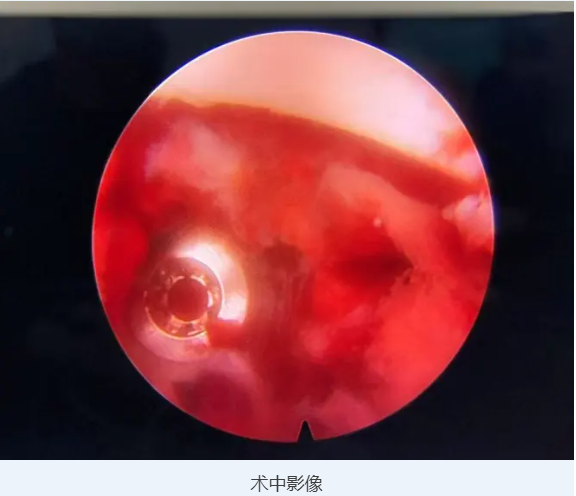 手术快讯|首都医科大学附属北京友谊医院祝斌教授开展Mega大通道脊柱内镜下腰椎后路椎板切除减压术+带前凸角可撑开融合器固定融合术