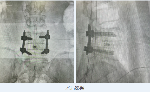 手术快讯|首都医科大学附属北京友谊医院祝斌教授开展Mega大通道脊柱内镜下腰椎后路椎板切除减压术+带前凸角可撑开融合器固定融合术